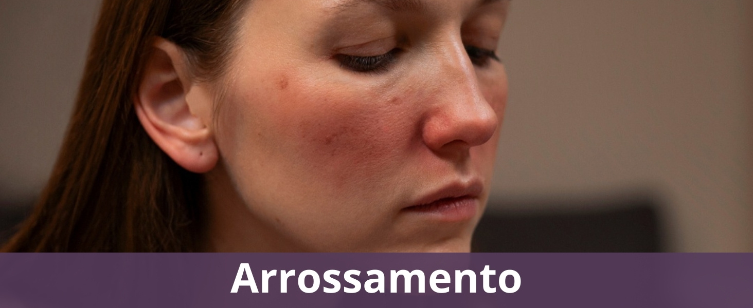 Arrossamento