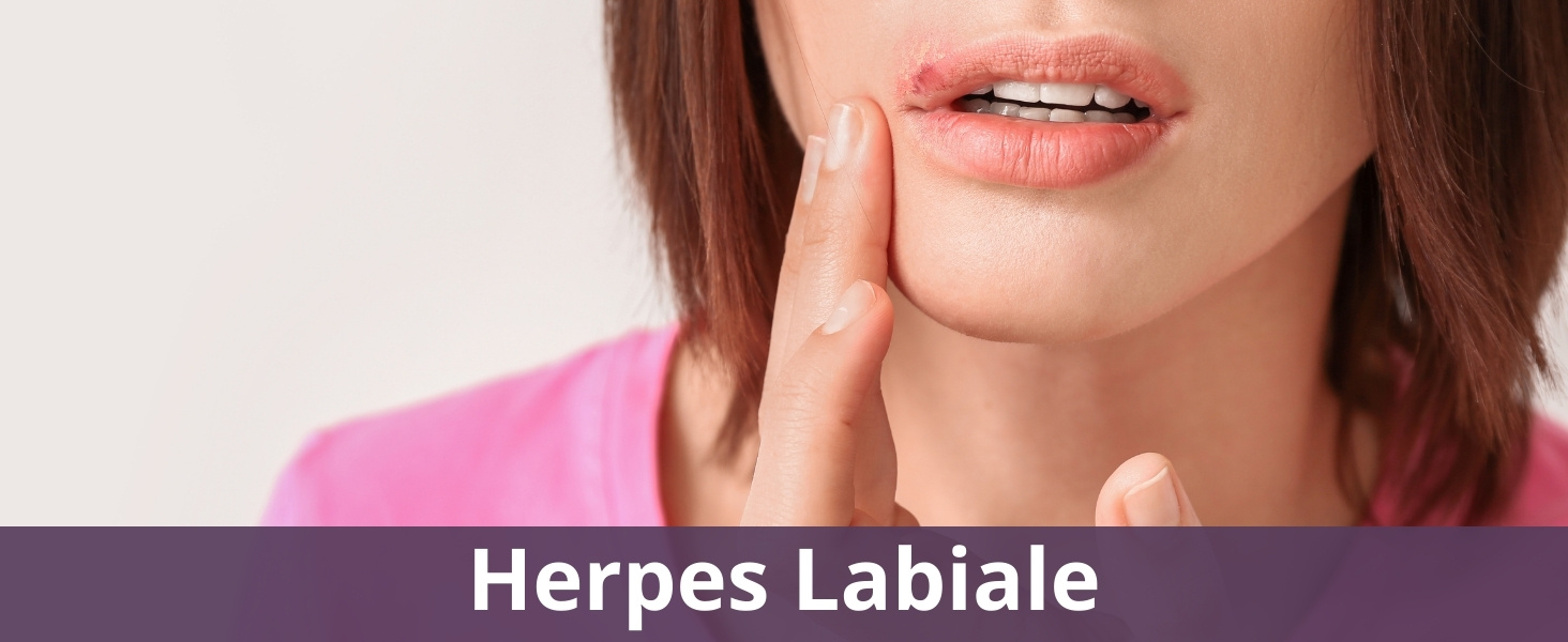 Herpes Labiale