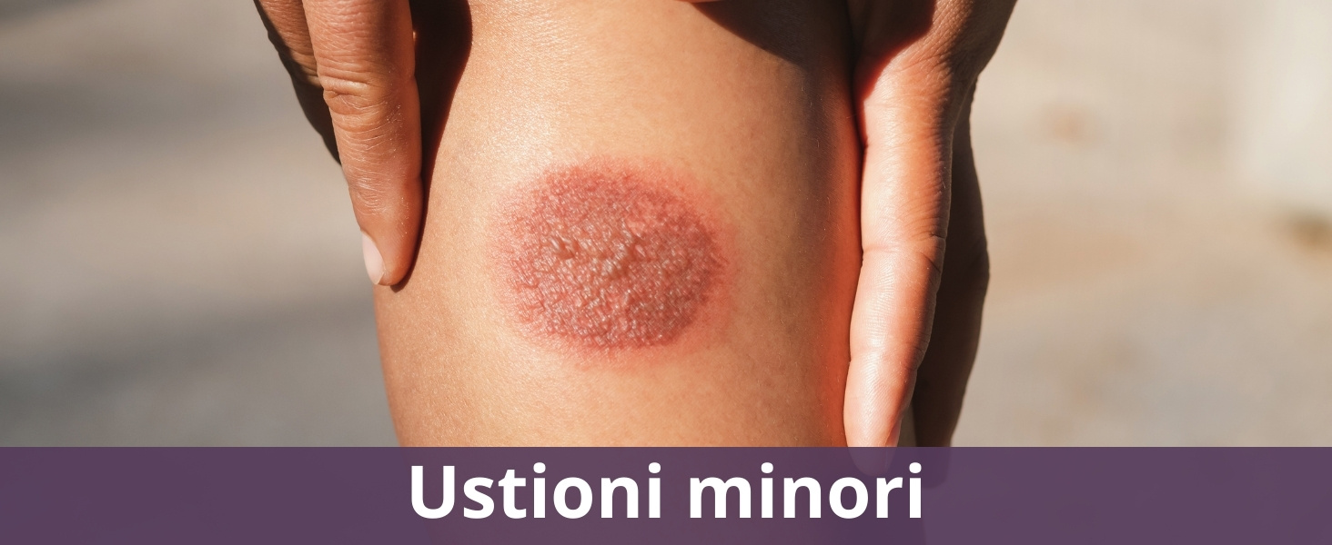 Ustioni minori